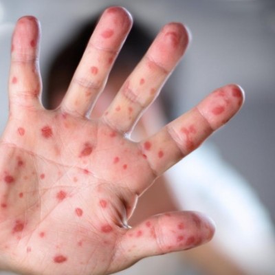 Улаанбурхан өвчний 1 тохиолдол батлагдлаа | HuduuMN